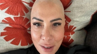 Işın Karaca Alopeci Universal tedavisi görüyor